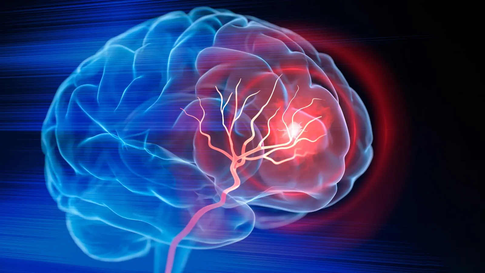 New injectable treatment helps the brain rebuild after stroke