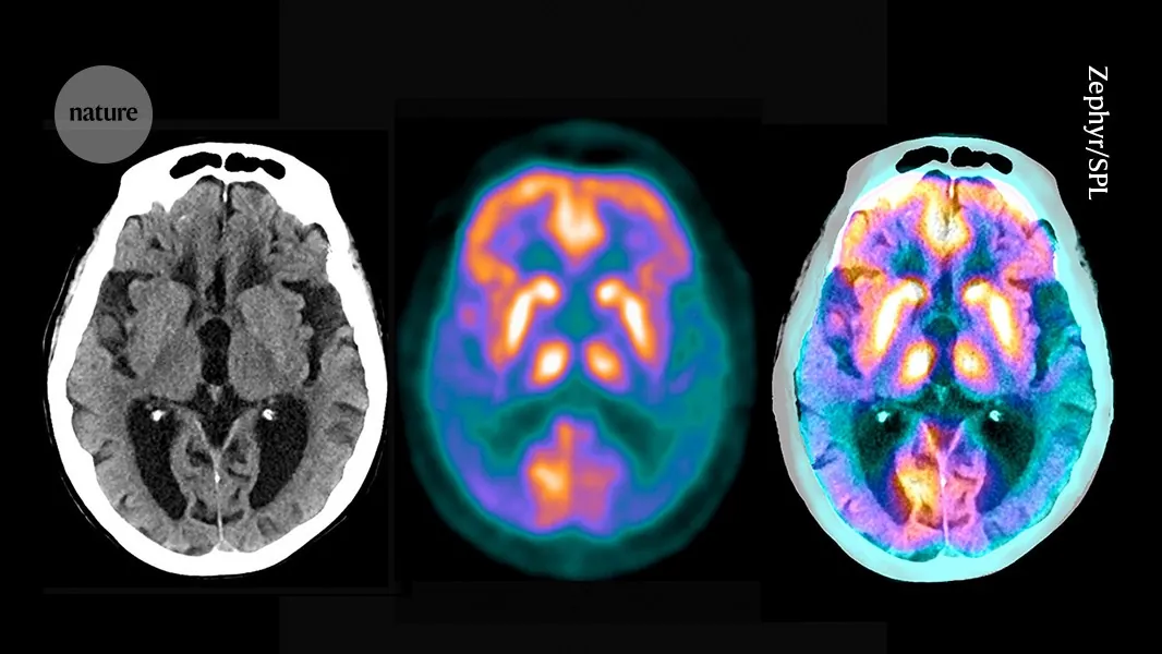 Map of brain ‘microproteins’ could offer new clues to Alzheimer’s disease