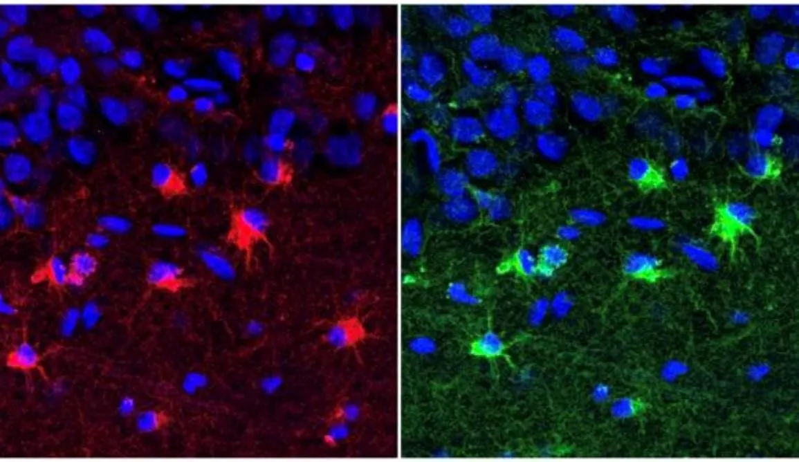 Abnormal Astroglia Linked to Fluid Intelligence Decline