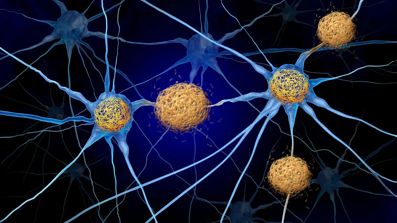 Scientists may have overlooked a hidden Alzheimer's culprit for decades