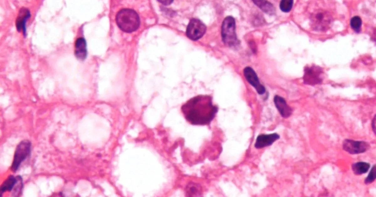 Senolytics improved liver fibrosis in a small randomized trial