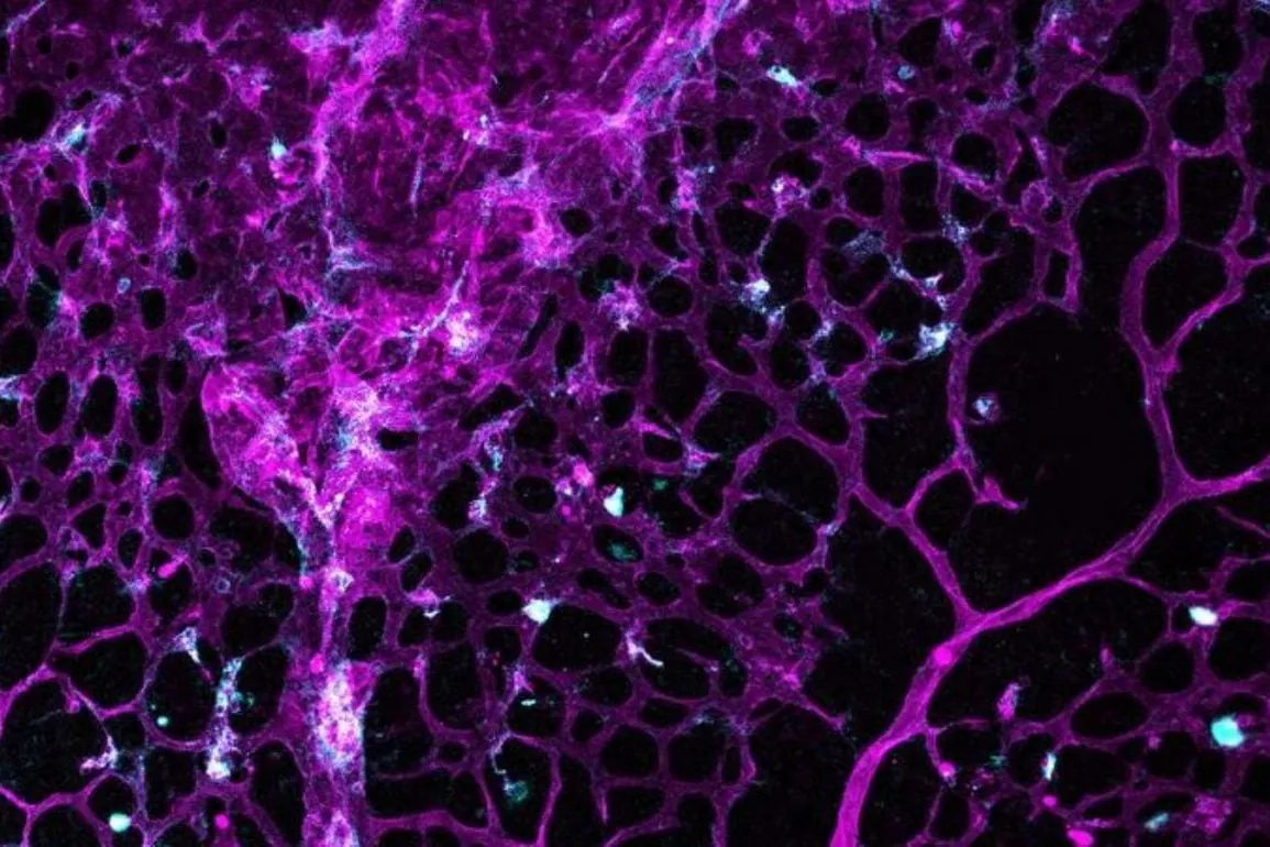 Cancer Drug Halts Fragile Brain Bleeds