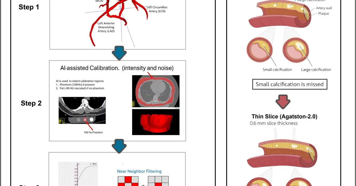 AI found coronary calcium in 22% of people with a zero score
