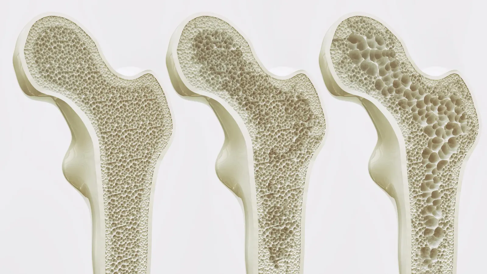 Millions take calcium and vitamin D for bone health. A major review finds little benefit