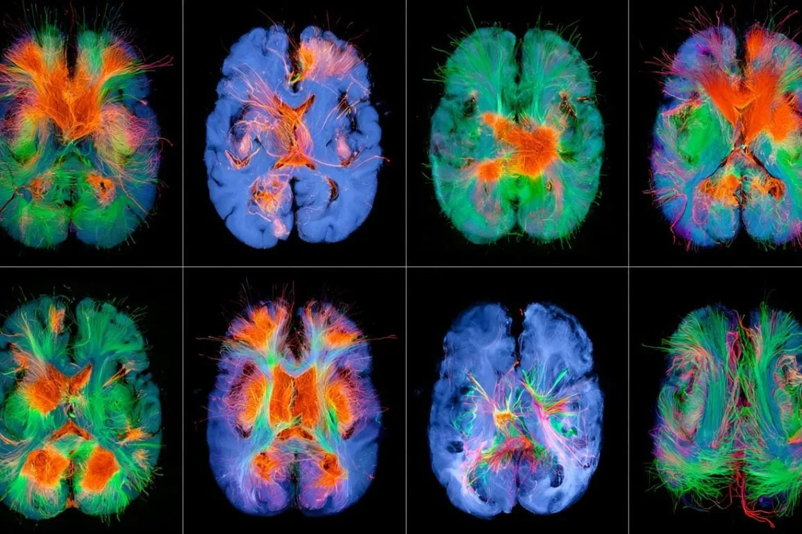 Early DBS Protects Cognition in Genetic Parkinson’s