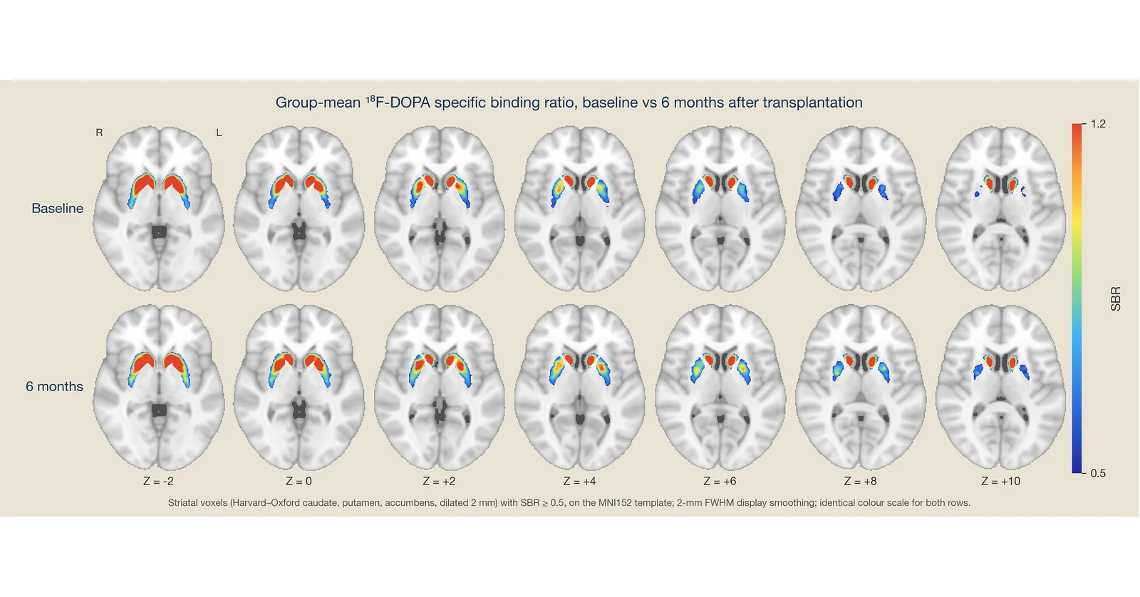 New Progress -- XellSmart Unveiled Phase I Results of Off-the-Shelf Parkinson