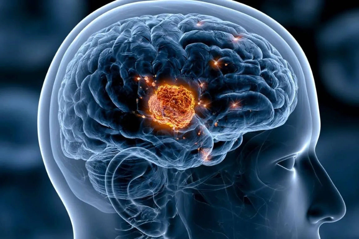 CAR-T Cell Therapy Eradicates Glioblastoma