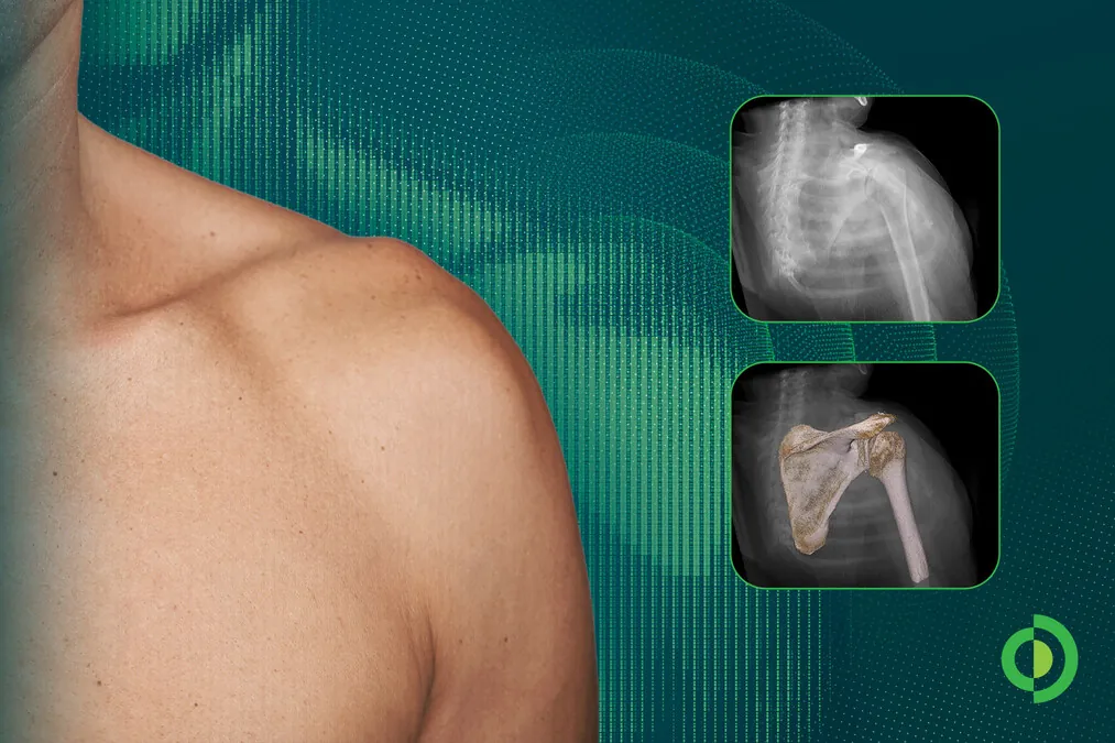 Advita Ortho Highlights New Research on AI-Generated Shoulder Digital Twins and Surgical Navigation at CAOS 2026 (PR Newswire)