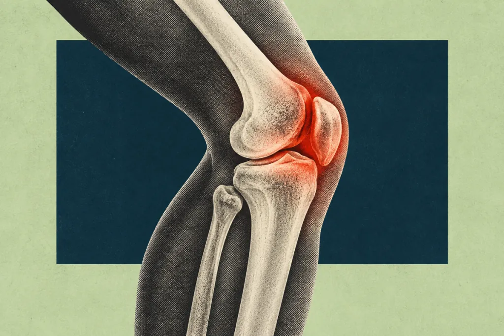 UK regulator takes up first OA disease drug