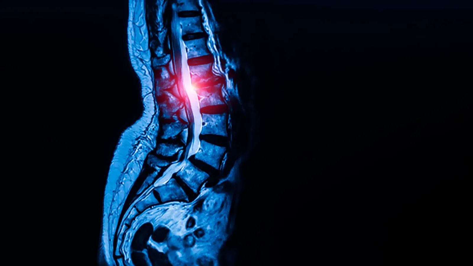 Hidden stem cells may be fueling spinal stenosis